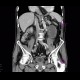 Upside-down stomach, small bowel obstruction, ileus, retained contrast in colonic diverticula: CT - Computed tomography